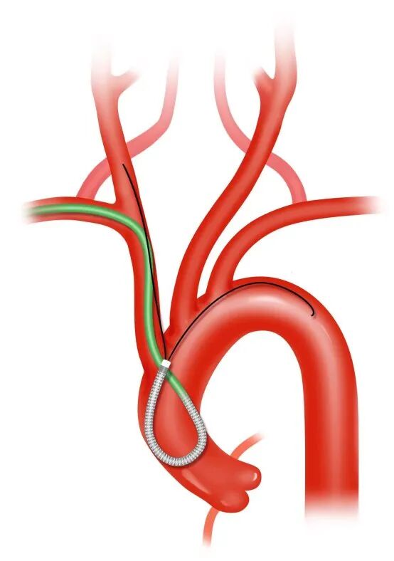 泥鳅导丝怎么用盘途问路，桡行而至丨ATTACH经桡中间导管成袢技术详解_https://www.jmylbn.com_新闻资讯_第12张
