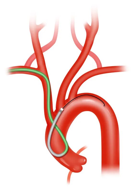 泥鳅导丝怎么用盘途问路，桡行而至丨ATTACH经桡中间导管成袢技术详解_https://www.jmylbn.com_新闻资讯_第13张