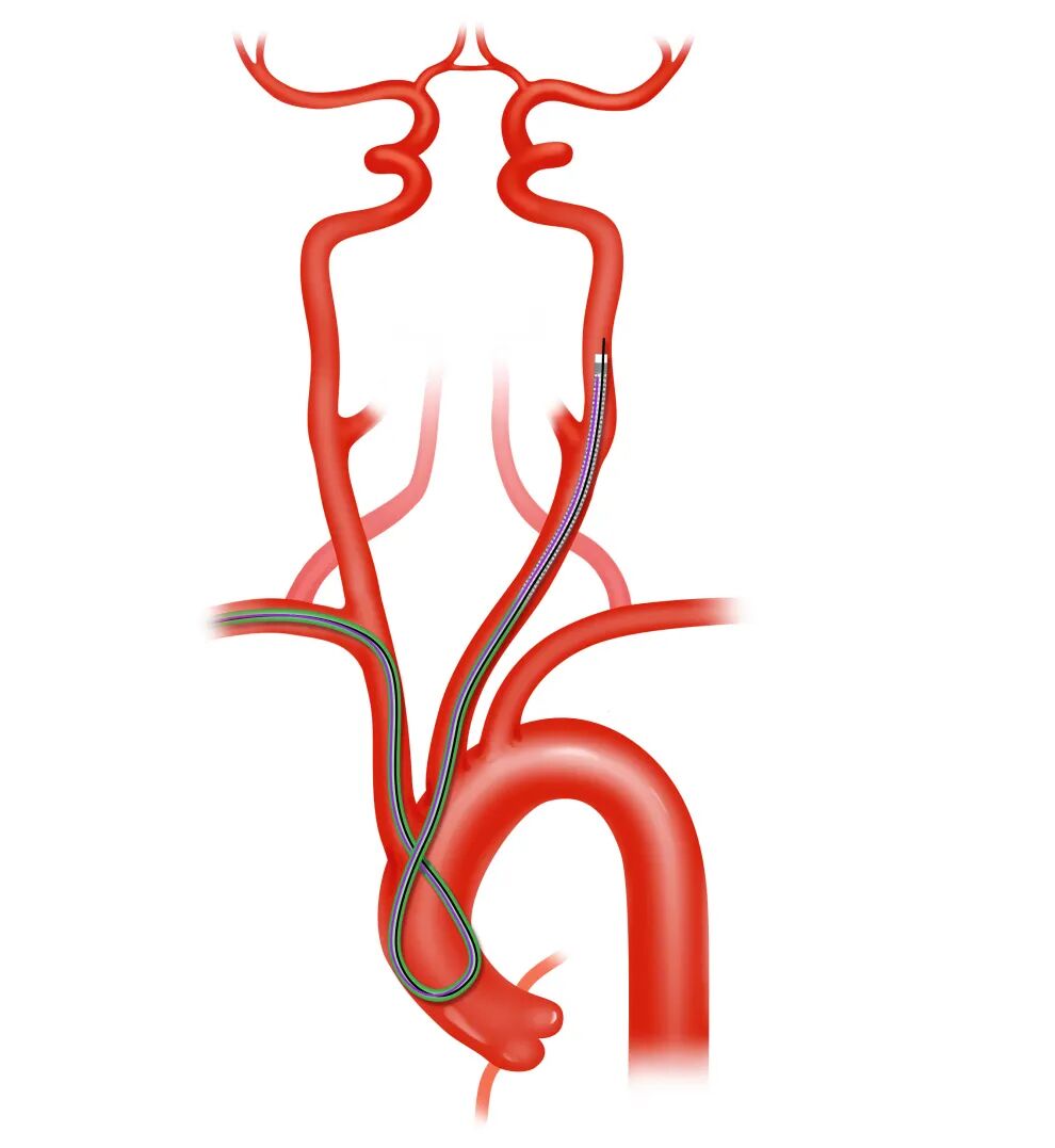 泥鳅导丝怎么用盘途问路，桡行而至丨ATTACH经桡中间导管成袢技术详解_https://www.jmylbn.com_新闻资讯_第19张