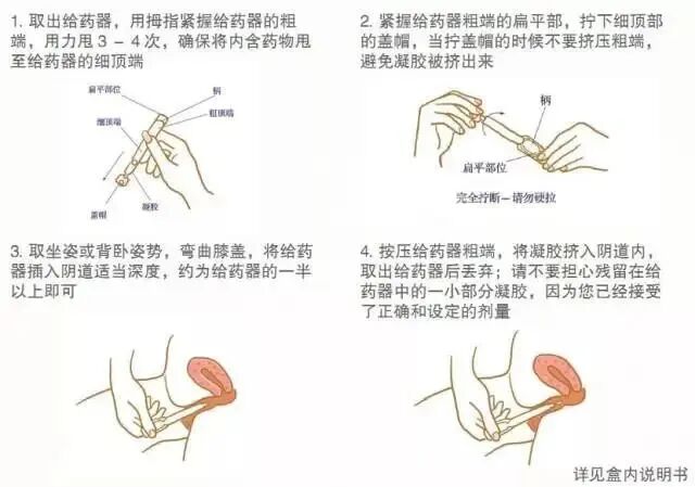 试管后的黄体酮保胎应该怎么用——打针、塞药还是口服？