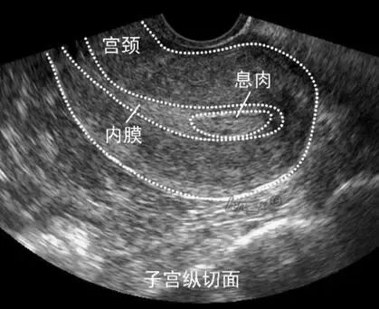 长在宫腔里的“多肉”是备孕之路的“绊脚石”！