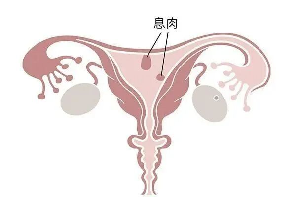 长在宫腔里的“多肉”是备孕之路的“绊脚石”！