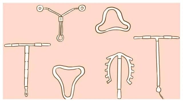 低调的不孕"真凶"——慢性子宫内膜炎！