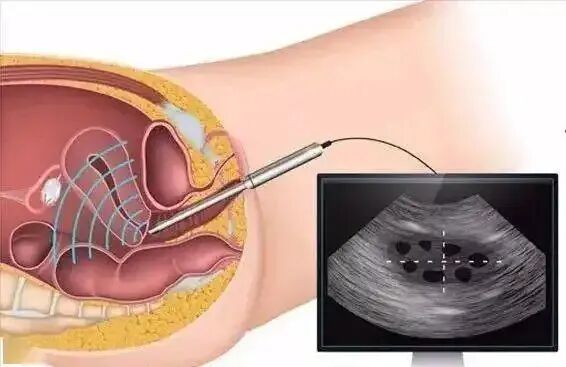 不得不知的卵巢早衰3个征兆和预防措施！