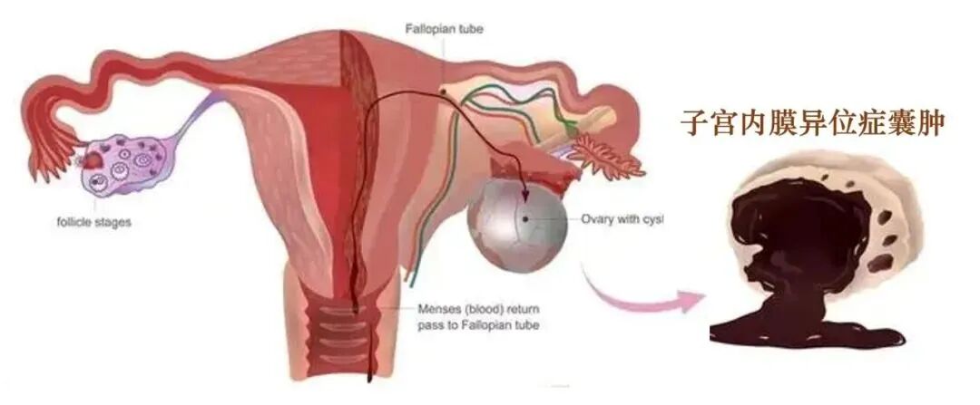 卵巢“巧克力囊肿”合并不孕，做手术还是试管?