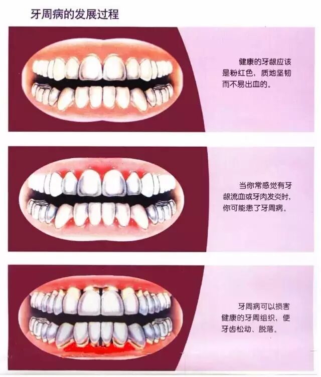 女子3年内怀孕4次都不幸流产，竟是牙周病作祟！