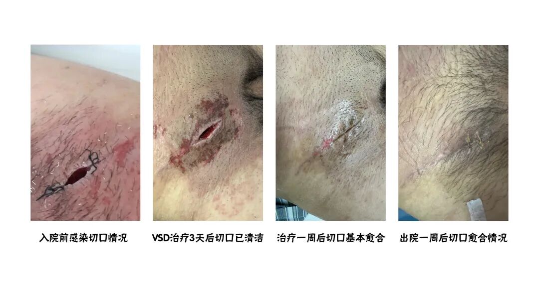 怎么促进vsd伤口愈合【亭医·医疗】VSD封闭式负压引流技术，慢性创面患者的福音_https://www.jmylbn.com_新闻资讯_第8张