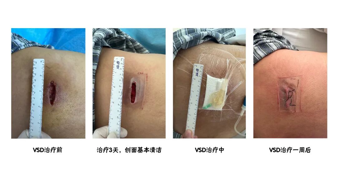 怎么促进vsd伤口愈合【亭医·医疗】VSD封闭式负压引流技术，慢性创面患者的福音_https://www.jmylbn.com_新闻资讯_第12张