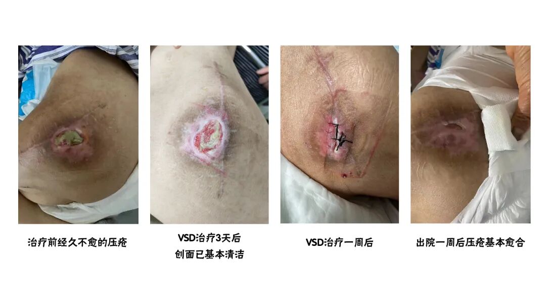 怎么促进vsd伤口愈合【亭医·医疗】VSD封闭式负压引流技术，慢性创面患者的福音_https://www.jmylbn.com_新闻资讯_第10张