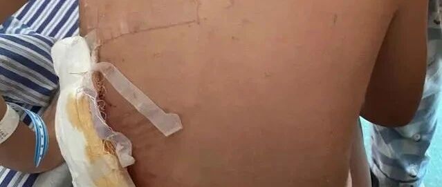 母女俩小区散步遭烈性犬大面积咬伤，狗主或担刑责，狗已被没收