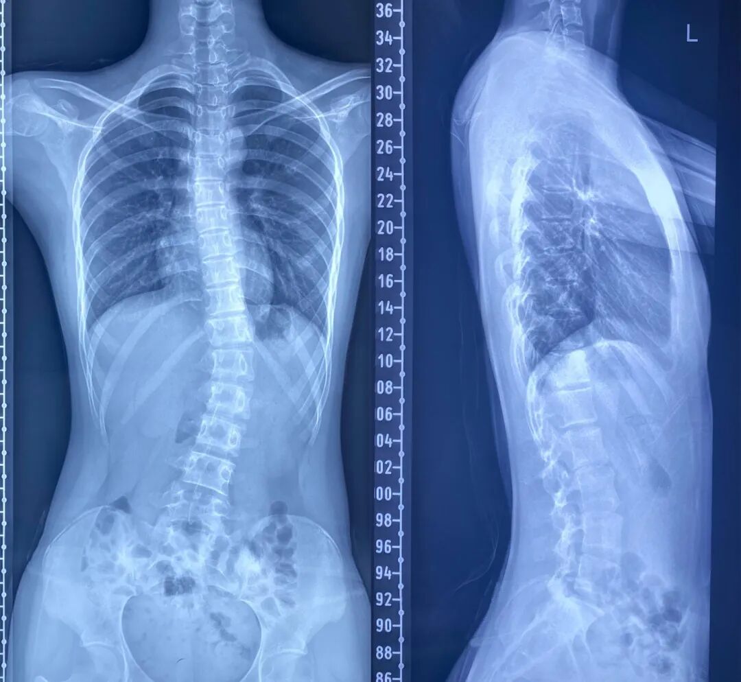 针灸治疗仪什么品牌好脊柱侧弯不用慌，“龙氏正骨”帮您忙~_https://www.jmylbn.com_新闻资讯_第5张