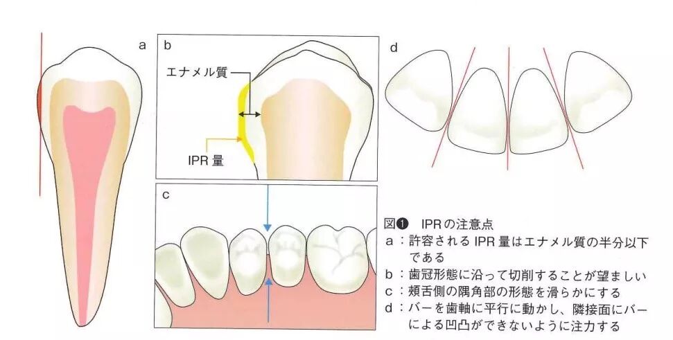 Ipr 隐形矫正邻面去釉 片切 Dr Samoto 佐本博 隐适美e学堂 微信公众号文章阅读 Wemp