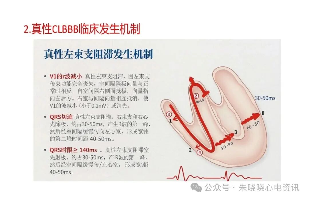 左束支阻滞再认识，实在太全了！