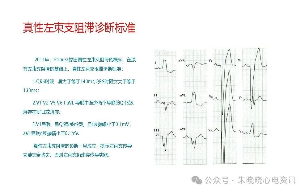 左束支阻滞再认识，实在太全了！