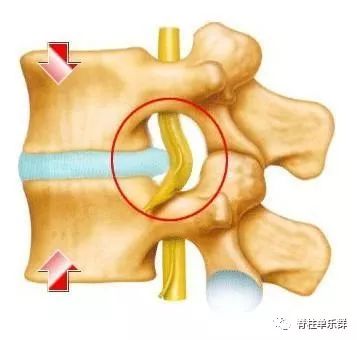 颈椎间盘突出症的诊断及治疗 脊柱单乐群 微信公众号文章阅读 Wemp