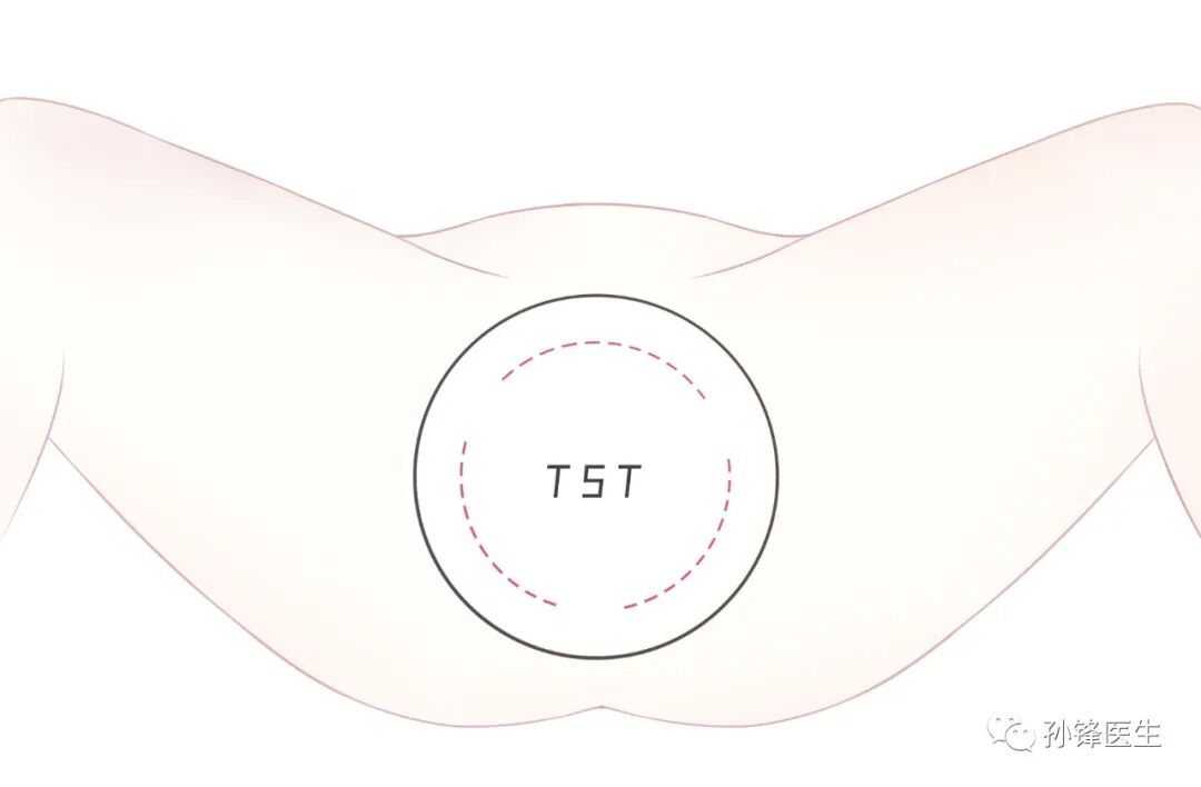 弧形吻合器怎么用痔的“星月术”：弧形直肠粘膜环切术+痔动脉结扎术_https://www.jmylbn.com_新闻资讯_第9张