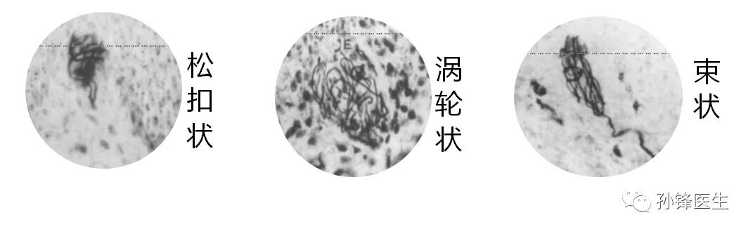 弧形吻合器怎么用痔的“星月术”：弧形直肠粘膜环切术+痔动脉结扎术_https://www.jmylbn.com_新闻资讯_第7张