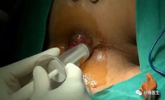 痔疮套扎吻合器怎么用医学笔记︱自动弹力线痔套扎术，治疗痔，很微创！（图文并茂）_https://www.jmylbn.com_新闻资讯_第8张