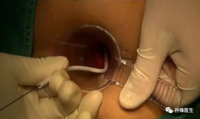 痔疮套扎吻合器怎么用医学笔记︱自动弹力线痔套扎术，治疗痔，很微创！（图文并茂）_https://www.jmylbn.com_新闻资讯_第17张