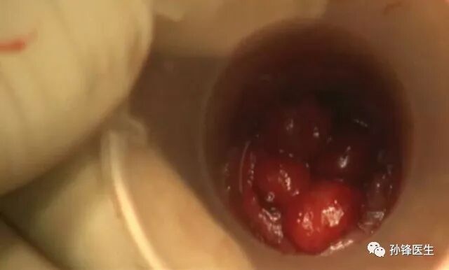 痔疮套扎吻合器怎么用医学笔记︱自动弹力线痔套扎术，治疗痔，很微创！（图文并茂）_https://www.jmylbn.com_新闻资讯_第20张