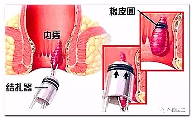 痔疮套扎吻合器怎么用医学笔记︱自动弹力线痔套扎术，治疗痔，很微创！（图文并茂）_https://www.jmylbn.com_新闻资讯_第3张