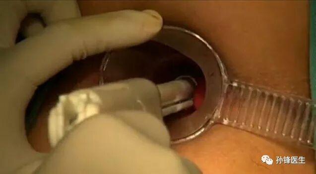 痔疮套扎吻合器怎么用医学笔记︱自动弹力线痔套扎术，治疗痔，很微创！（图文并茂）_https://www.jmylbn.com_新闻资讯_第11张