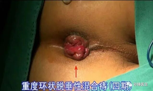 痔疮套扎吻合器怎么用医学笔记︱自动弹力线痔套扎术，治疗痔，很微创！（图文并茂）_https://www.jmylbn.com_新闻资讯_第5张