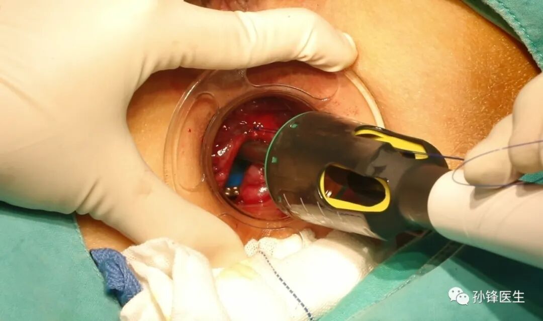 弧形吻合器怎么用痔的“星月术”：弧形直肠粘膜环切术+痔动脉结扎术_https://www.jmylbn.com_新闻资讯_第24张