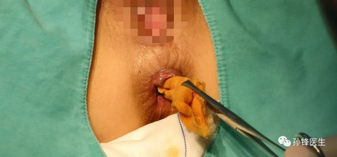 弧形吻合器怎么用痔的“星月术”：弧形直肠粘膜环切术+痔动脉结扎术_https://www.jmylbn.com_新闻资讯_第14张