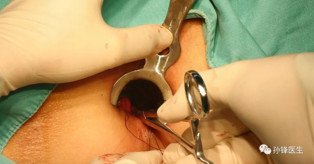 弧形吻合器怎么用痔的“星月术”：弧形直肠粘膜环切术+痔动脉结扎术_https://www.jmylbn.com_新闻资讯_第29张
