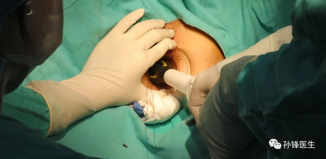 弧形吻合器怎么用痔的“星月术”：弧形直肠粘膜环切术+痔动脉结扎术_https://www.jmylbn.com_新闻资讯_第25张