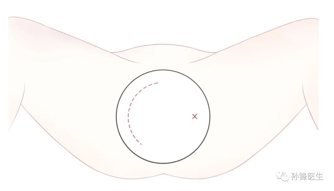 弧形吻合器怎么用痔的“星月术”：弧形直肠粘膜环切术+痔动脉结扎术_https://www.jmylbn.com_新闻资讯_第11张
