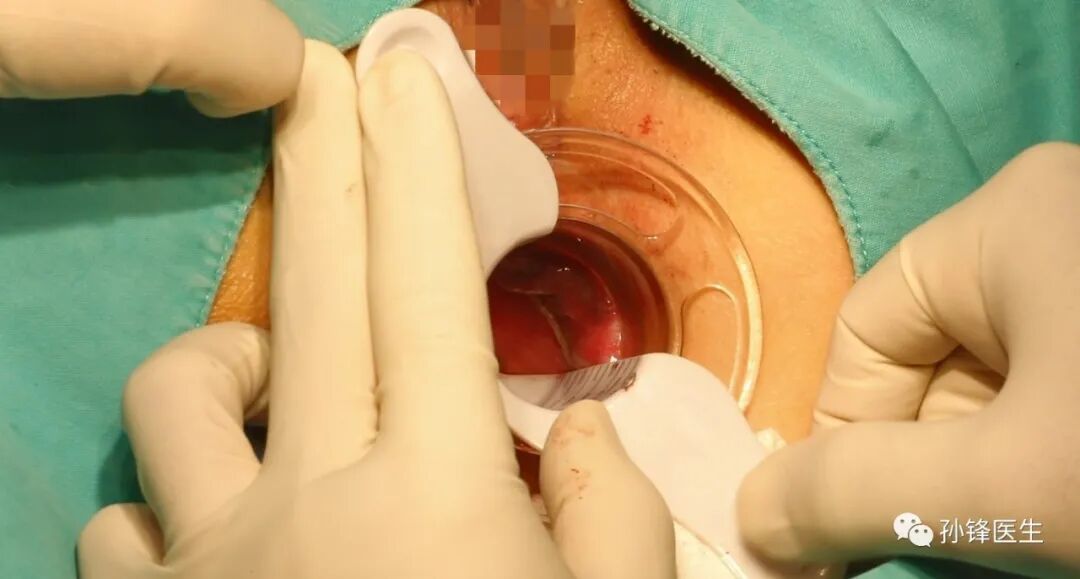 弧形吻合器怎么用痔的“星月术”：弧形直肠粘膜环切术+痔动脉结扎术_https://www.jmylbn.com_新闻资讯_第27张