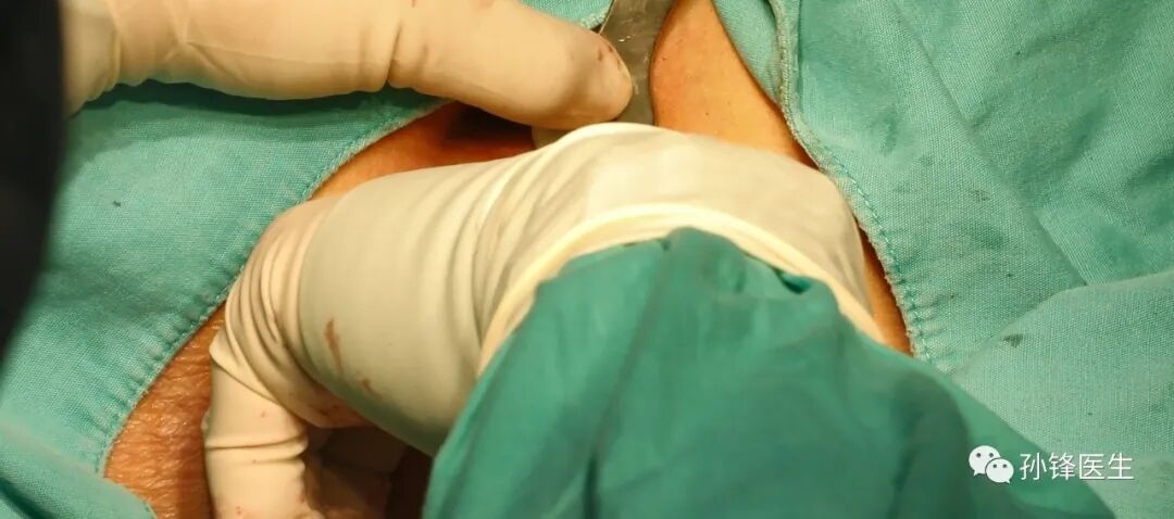 弧形吻合器怎么用痔的“星月术”：弧形直肠粘膜环切术+痔动脉结扎术_https://www.jmylbn.com_新闻资讯_第28张