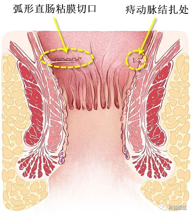 弧形吻合器怎么用痔的“星月术”：弧形直肠粘膜环切术+痔动脉结扎术_https://www.jmylbn.com_新闻资讯_第31张
