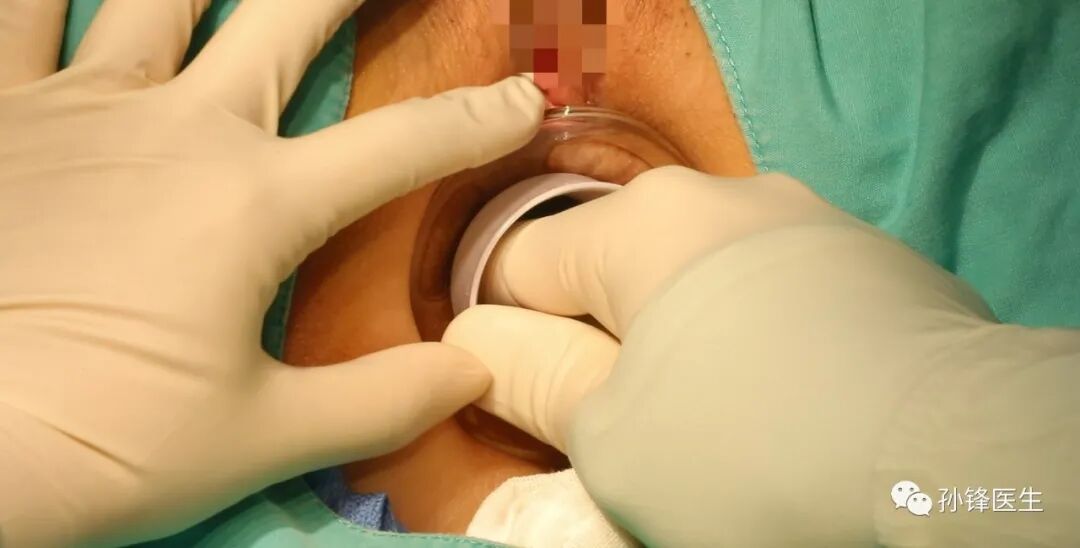 弧形吻合器怎么用痔的“星月术”：弧形直肠粘膜环切术+痔动脉结扎术_https://www.jmylbn.com_新闻资讯_第17张