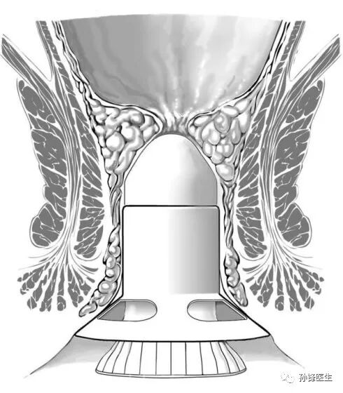 弧形吻合器怎么用痔的“星月术”：弧形直肠粘膜环切术+痔动脉结扎术_https://www.jmylbn.com_新闻资讯_第16张