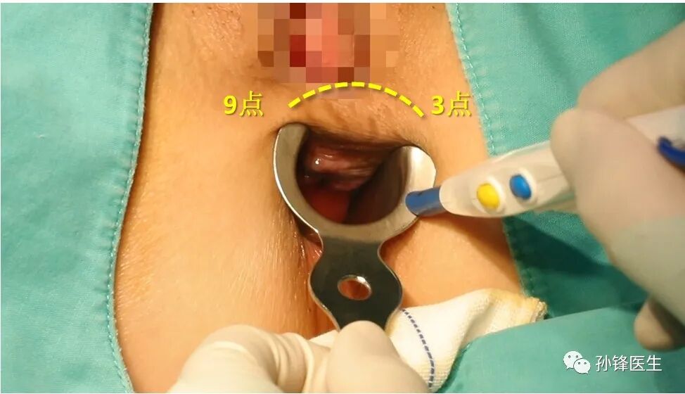 弧形吻合器怎么用痔的“星月术”：弧形直肠粘膜环切术+痔动脉结扎术_https://www.jmylbn.com_新闻资讯_第15张