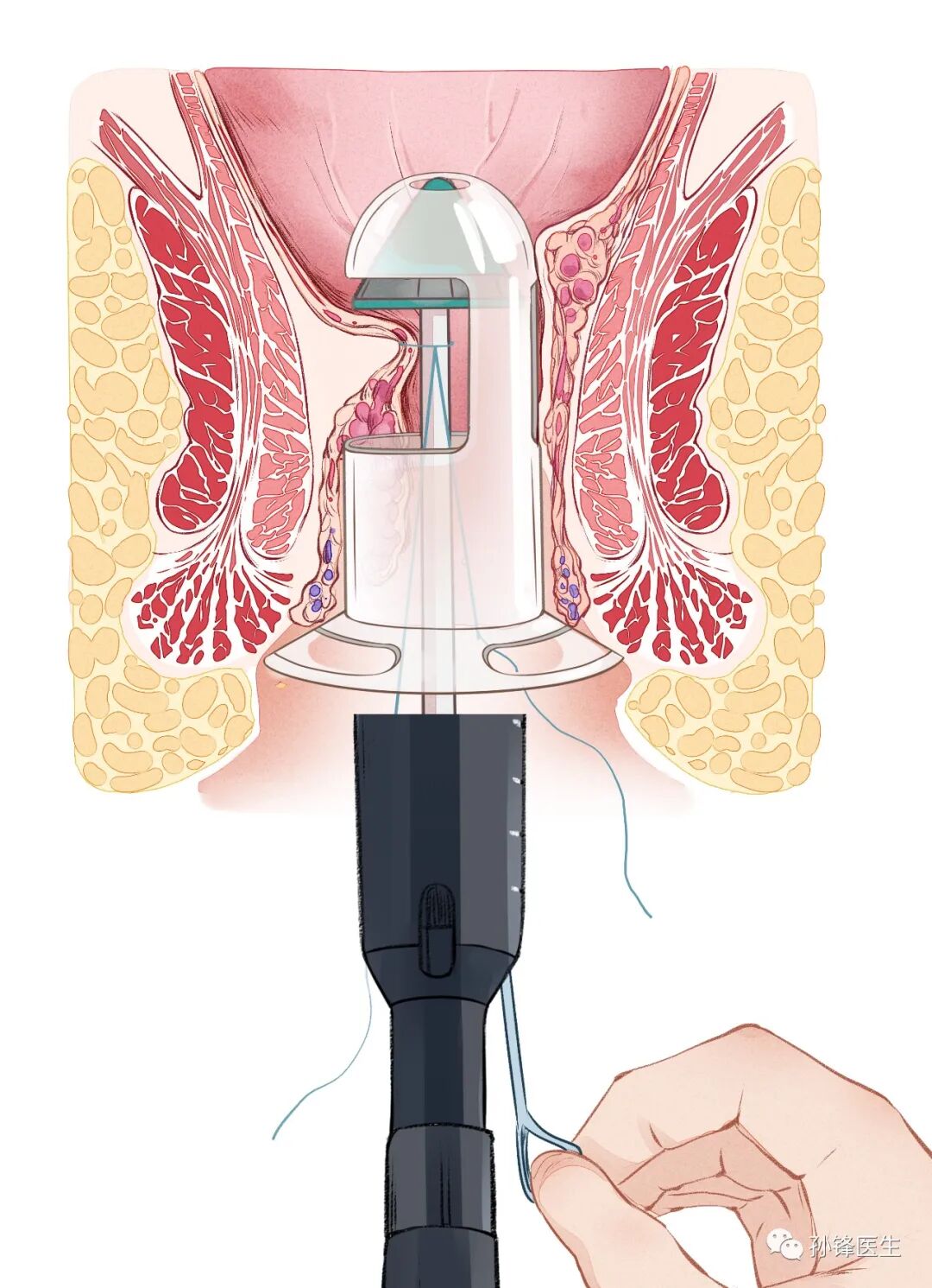 弧形吻合器怎么用痔的“星月术”：弧形直肠粘膜环切术+痔动脉结扎术_https://www.jmylbn.com_新闻资讯_第21张