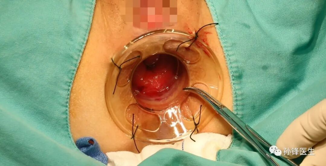 弧形吻合器怎么用痔的“星月术”：弧形直肠粘膜环切术+痔动脉结扎术_https://www.jmylbn.com_新闻资讯_第18张