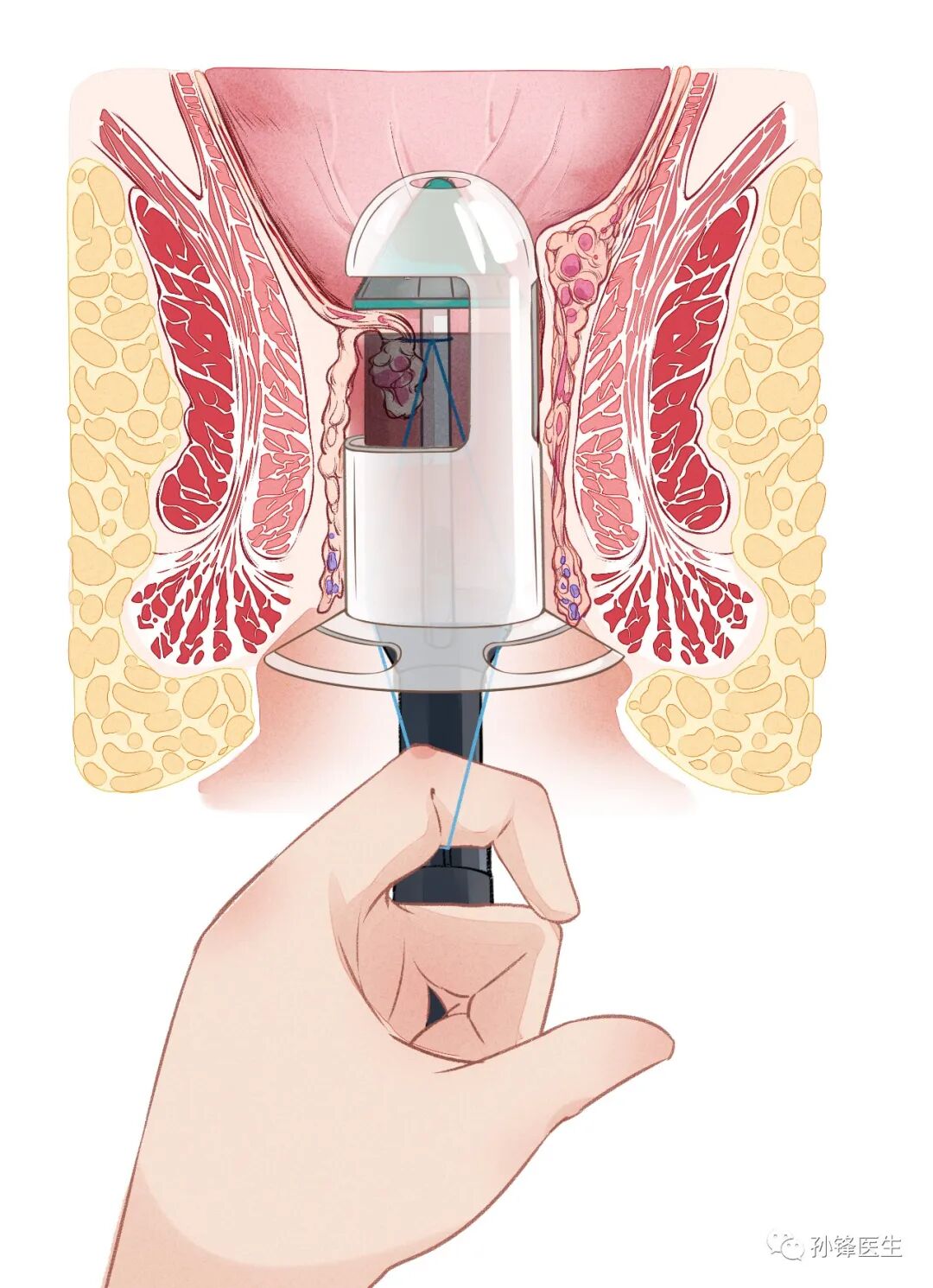 弧形吻合器怎么用痔的“星月术”：弧形直肠粘膜环切术+痔动脉结扎术_https://www.jmylbn.com_新闻资讯_第23张