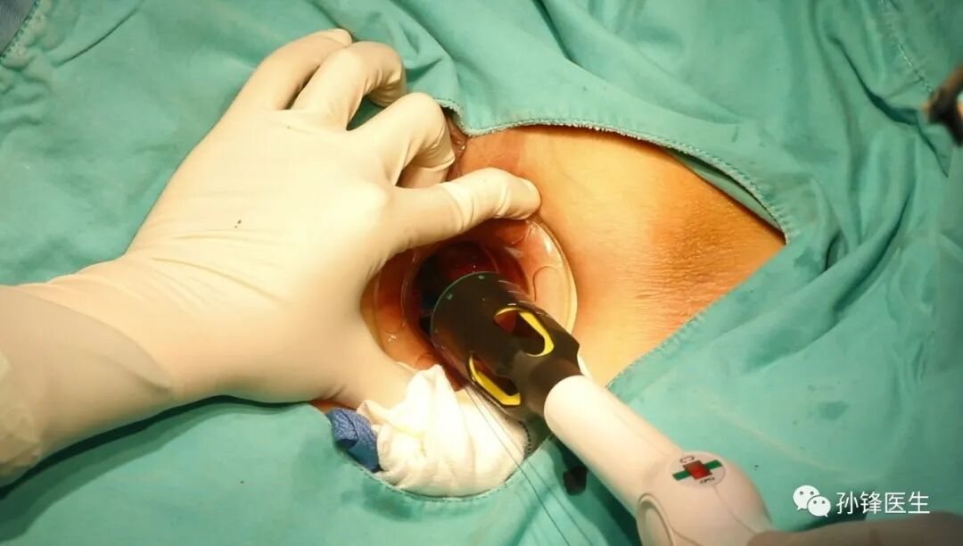 弧形吻合器怎么用痔的“星月术”：弧形直肠粘膜环切术+痔动脉结扎术_https://www.jmylbn.com_新闻资讯_第22张