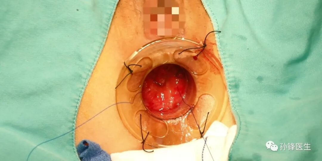 弧形吻合器怎么用痔的“星月术”：弧形直肠粘膜环切术+痔动脉结扎术_https://www.jmylbn.com_新闻资讯_第20张