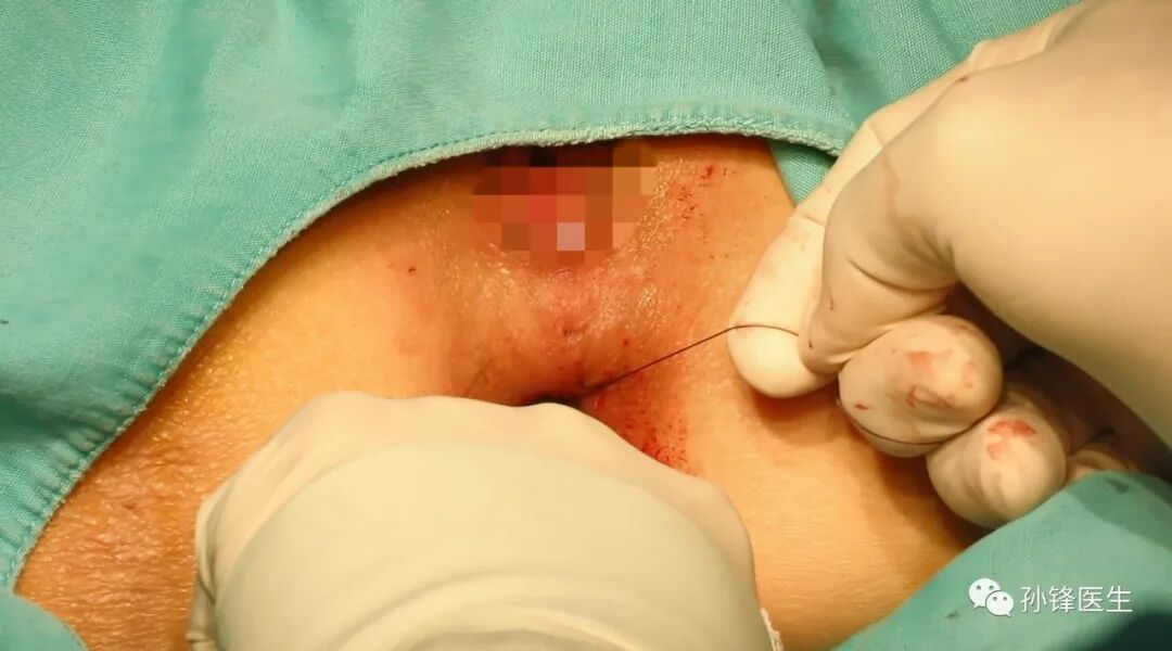 弧形吻合器怎么用痔的“星月术”：弧形直肠粘膜环切术+痔动脉结扎术_https://www.jmylbn.com_新闻资讯_第30张