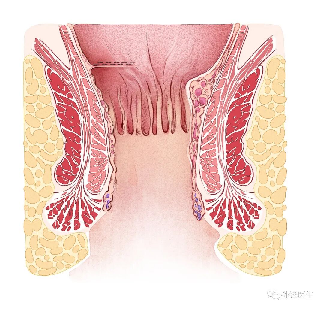 弧形吻合器怎么用痔的“星月术”：弧形直肠粘膜环切术+痔动脉结扎术_https://www.jmylbn.com_新闻资讯_第26张