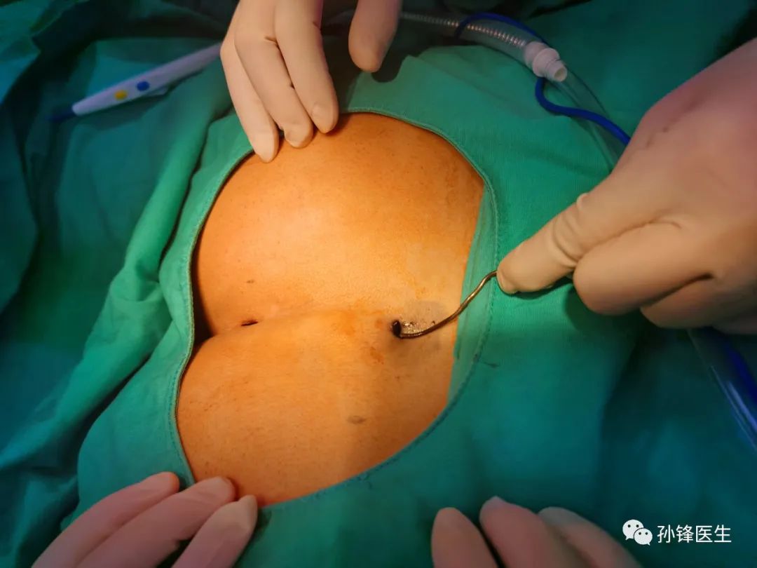 手把手教你:藏毛窦原位适形皮片移植术_医学界-助力医生临床决策和