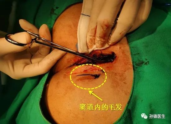 手把手教你:藏毛窦原位适形皮片移植术_医学界-助力医生临床决策和职