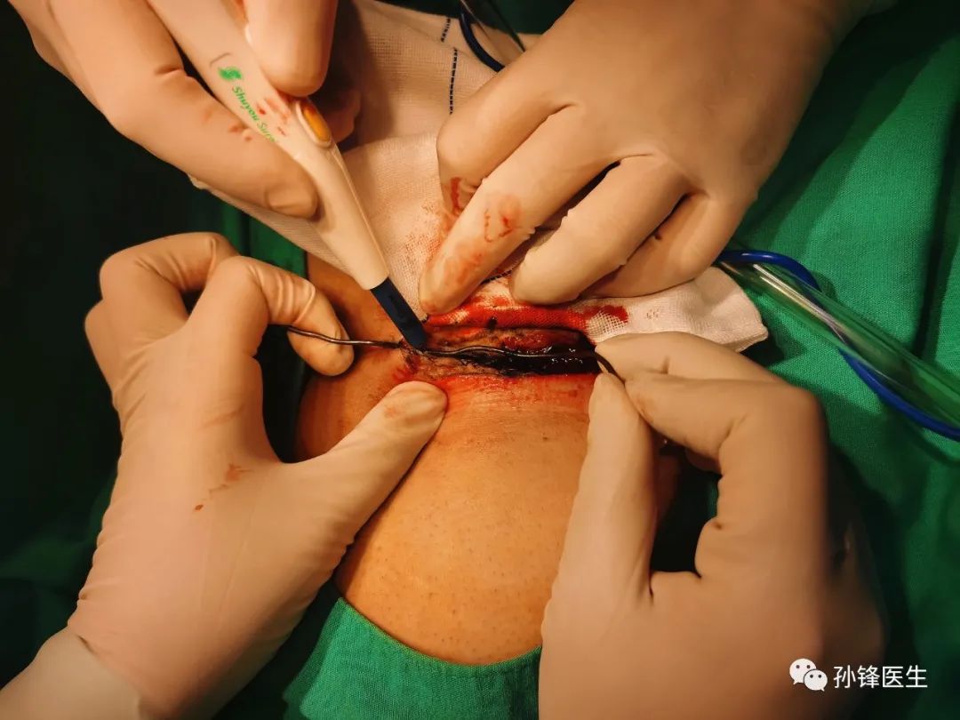 适形皮片移植通过上述的手术步骤,我们已经完成了藏毛窦病灶的切除