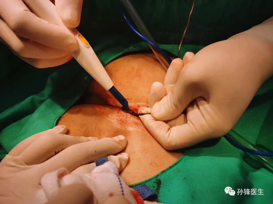 适形皮片移植通过上述的手术步骤,我们已经完成了藏毛窦病灶的切除