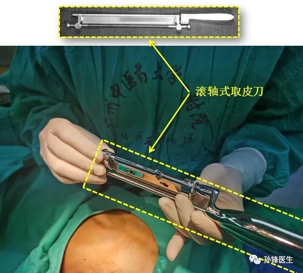 方法,如下图(6),本例患者术者选用的是价格较为低廉的"滚轴式取皮刀"